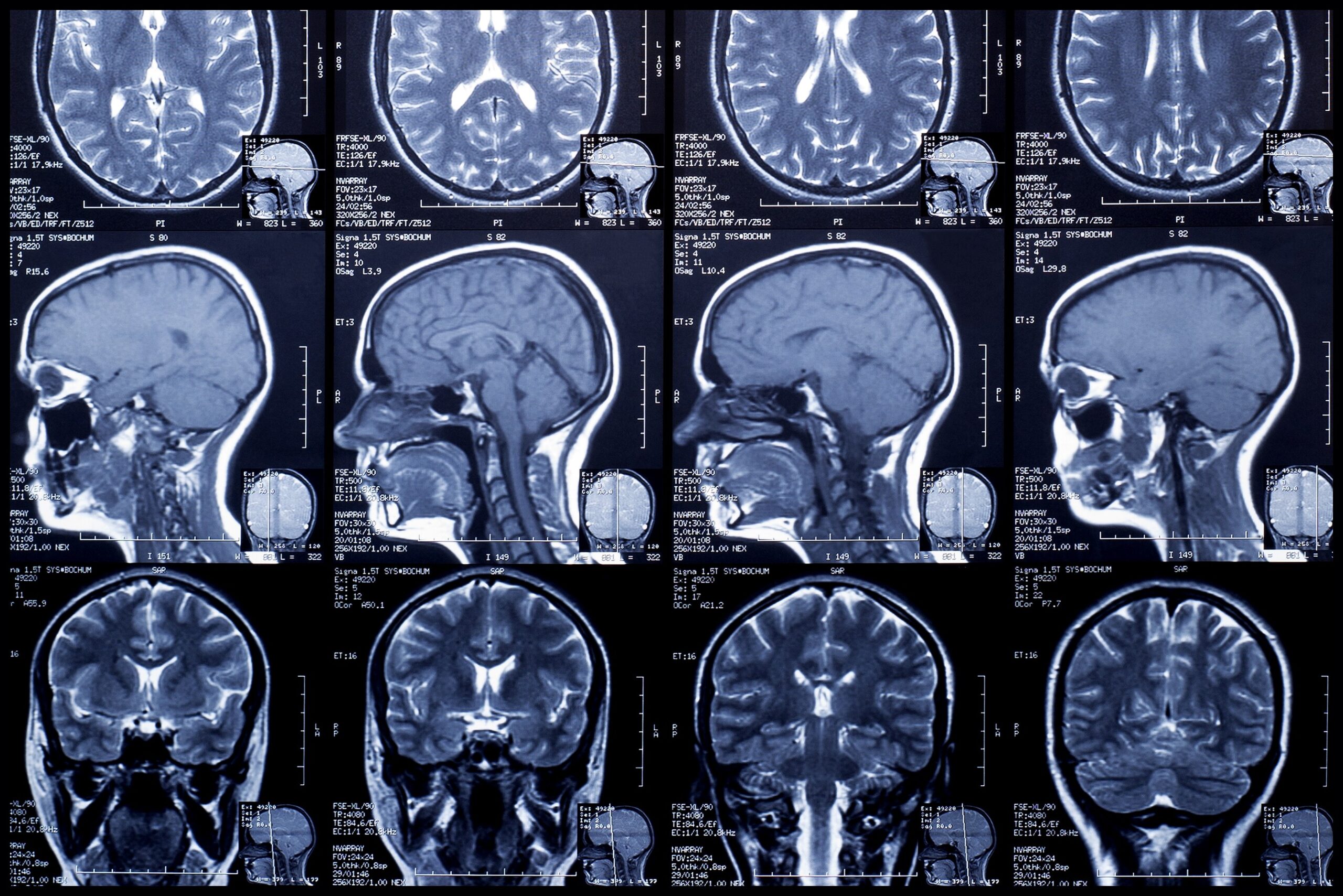 Abu Dhabi hospital reveals new brain scan to detect Alzheimer’s earlier